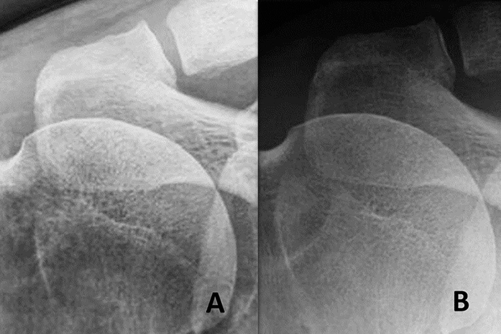 Radiografia di una spalla con tendinopatie calcifiche